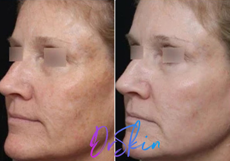 UltraClear-BA-1-TREATMENT-5-WKS-POST