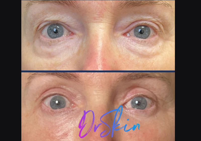 UltraClear-BA-1-TREATMENT-6-WEEKS-POST