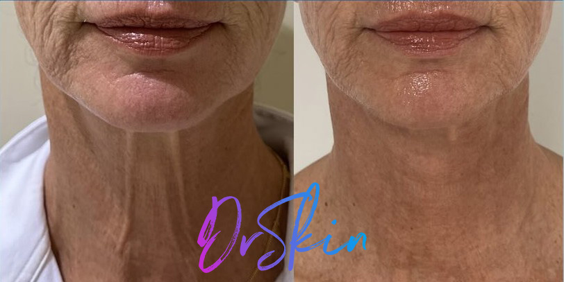 UltraClear-BA-1-TREATMENT-8-WKS-POST