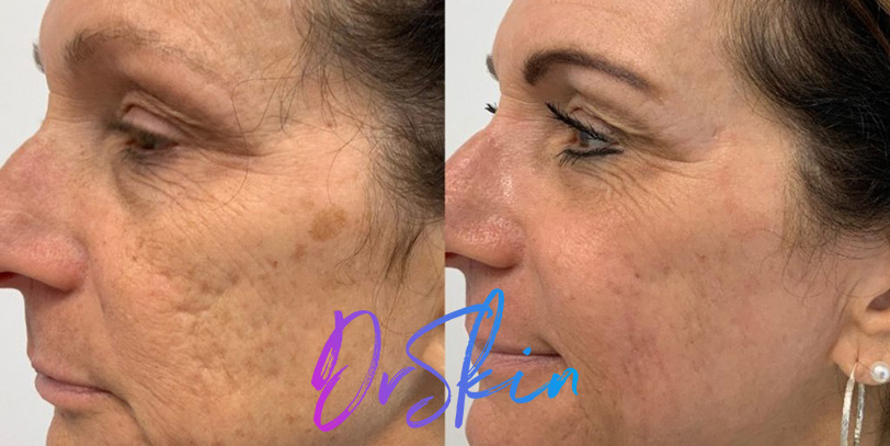 UltraClear-BAs-2-TREATMENTS-1024x444