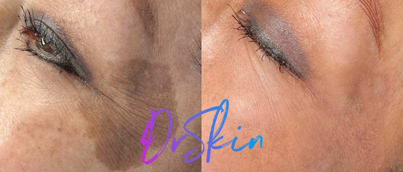 UltraClear-BAs-2-TREATMENTS-1024x444